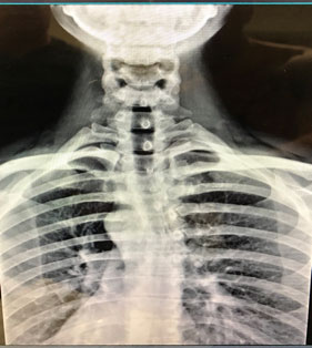 My Injury Story