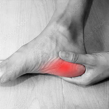 Plantar Fasciitis